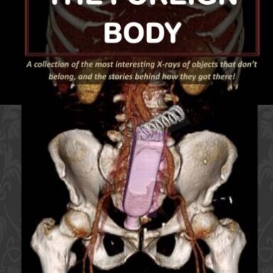 The Foreign Body: A Collection of the Most Interesting X-Rays of Things That Don’t Belong and the Stories Behind How They Got There!